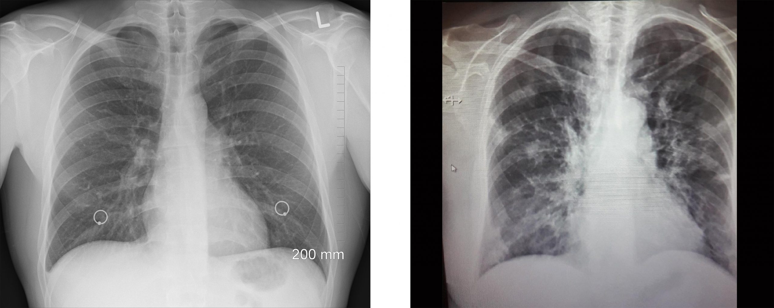 Pľúca zdravého pacienta vs. pľúca covid pacienta